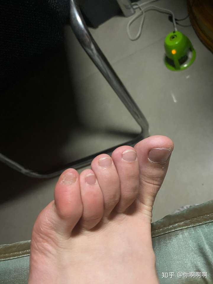 第四脚趾短小症?