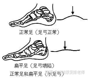 扁平足如何自我判断