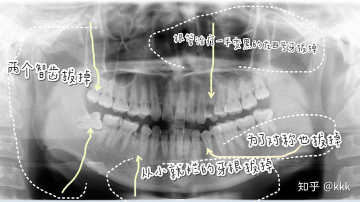 20岁牙齿矫正算不算太迟