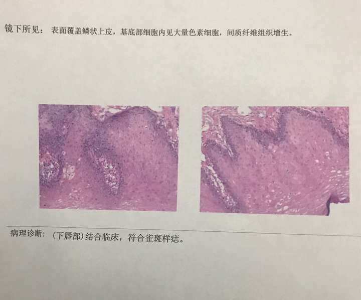 脸上突然长黑斑是什么原因_下嘴唇有黑斑是什么病_嘴唇有黑斑是什么原因