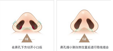 鼻翼很大该选用哪一种鼻翼缩小术内切还是外切