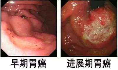 发现胃癌后要不要手术治疗