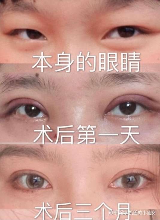 我这眼睛是因为内眦赘皮引起的斜视么?
