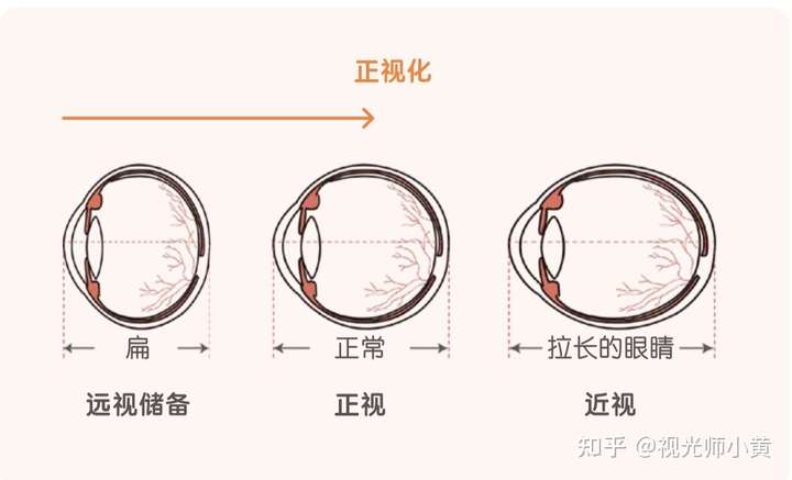 孩子配眼镜需要测眼轴需要使用生物测量仪吗