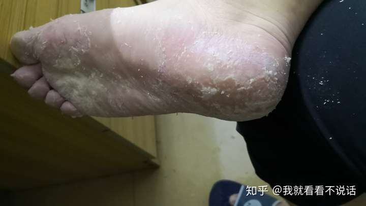 说说你的脚气怎么治好的?