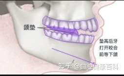 杭州(国际)牙科医院张丽文:正畸颌垫