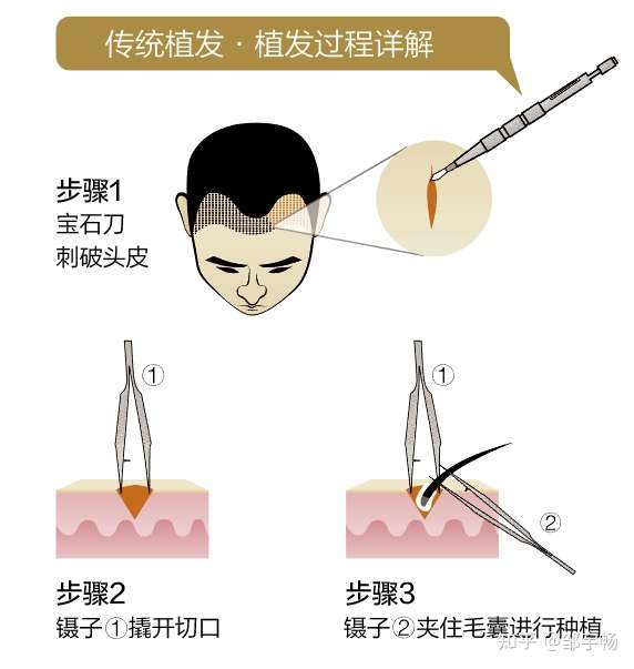 图:传统植发手术步骤(演示) 相对于前两种植发技术,微针植发是受到