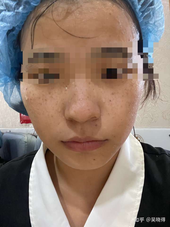 激光祛斑可以去雀斑吗?