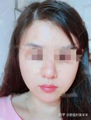 北京面部吸脂哪里做得好?