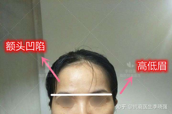 两边眉骨长得高低不同怎么搞呜呜?