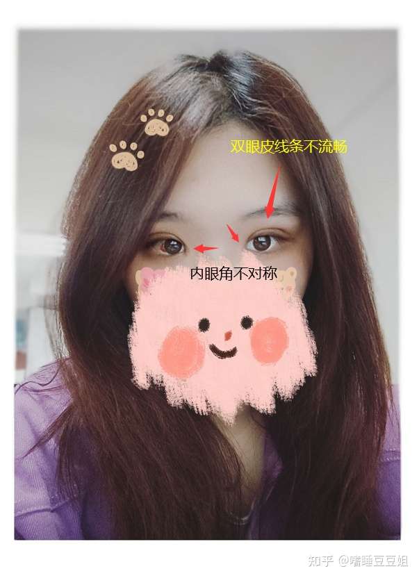 全切双眼皮失败如何维权?