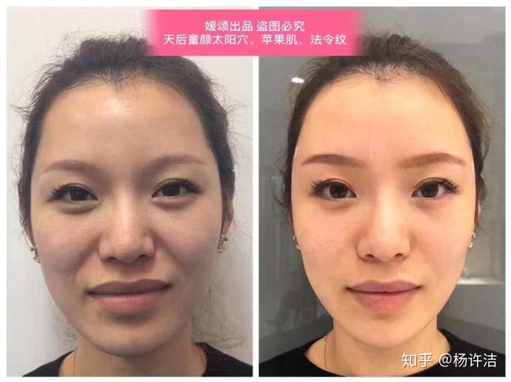 有人知道这种法令纹形成的原因什么吗?