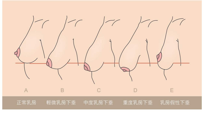 我们的乳房自身是有重量的,很多外观"看上去"被认为"的下垂其实并不