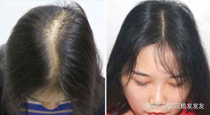 女生头发少怎样增加发量让头发变多?