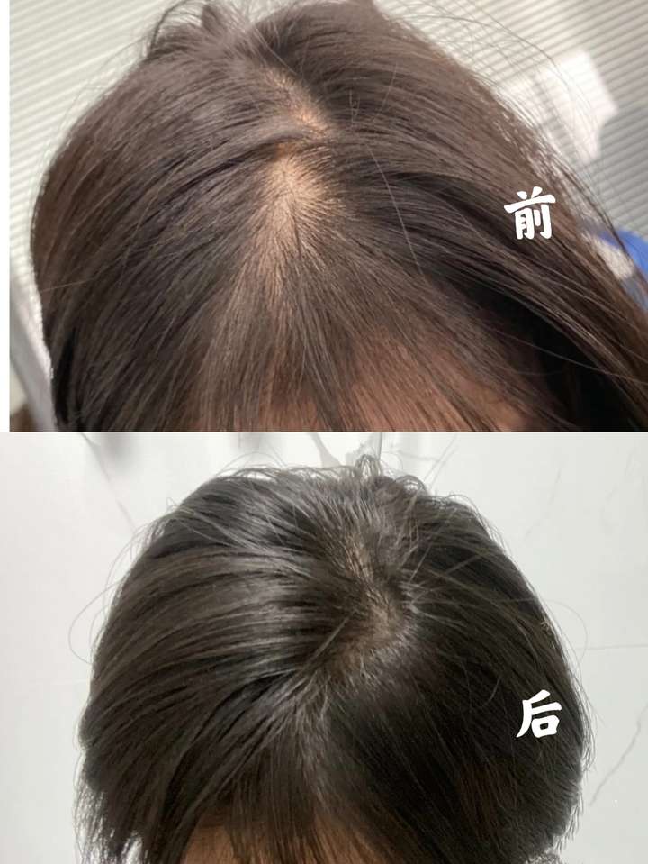 女生脱发严重用什么洗发水?