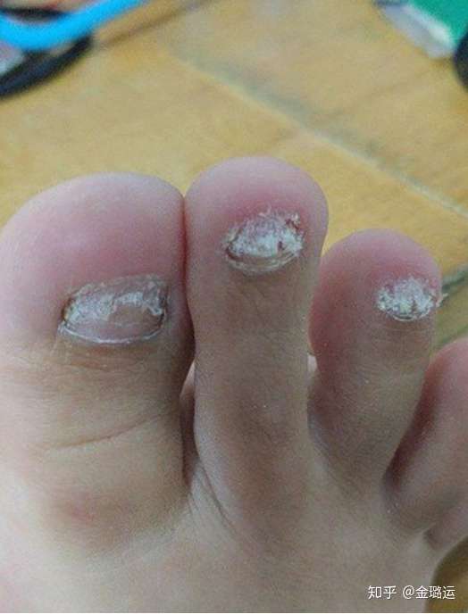 哪里能治疗灰指甲?