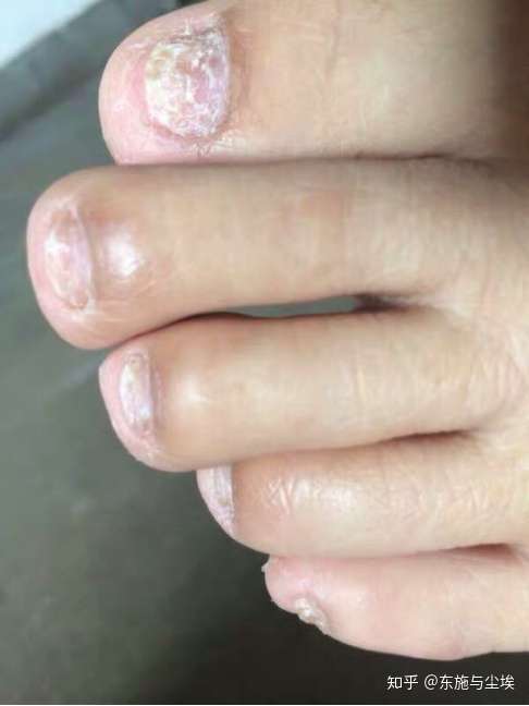 灰指甲是由真菌感染引发的,使真菌传染的最主要原因就是经常搔抓,是
