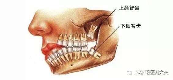 为什么口腔医生都喜欢拔智齿?