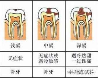 龋坏根据坏的程度不同又分为浅龋,中龋和深龋.