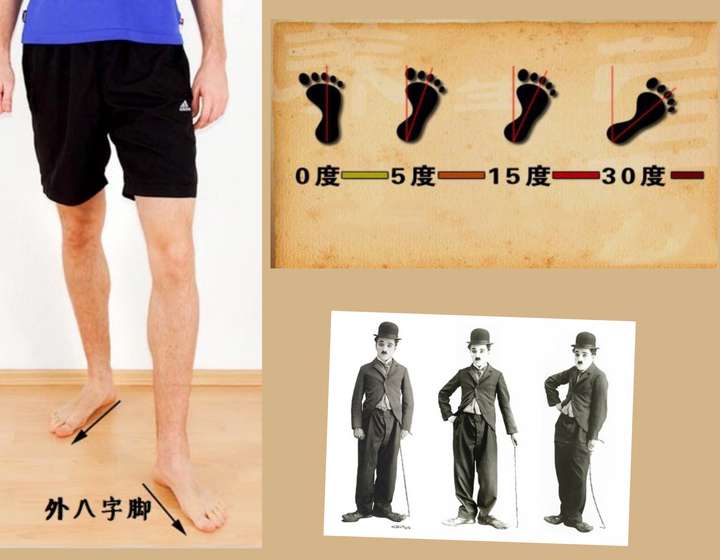 走路时候一直外八字,怎么走都不好看,双脚努力不外八字走路,却发现