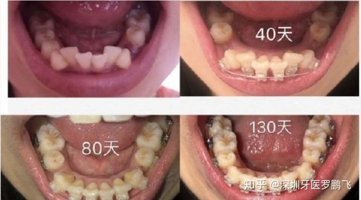 牙齿正畸一定要拔牙吗?