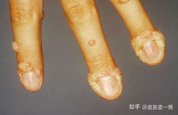 寻常疣的皮肤特征 1,初期长的像粟粒丘疹,后其可大若黄豆,突起皮表