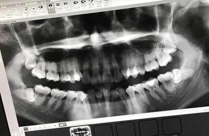 正畸前的牙齿扫描