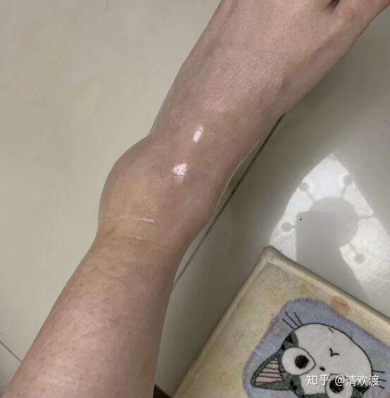 烫伤可不可以洗澡?