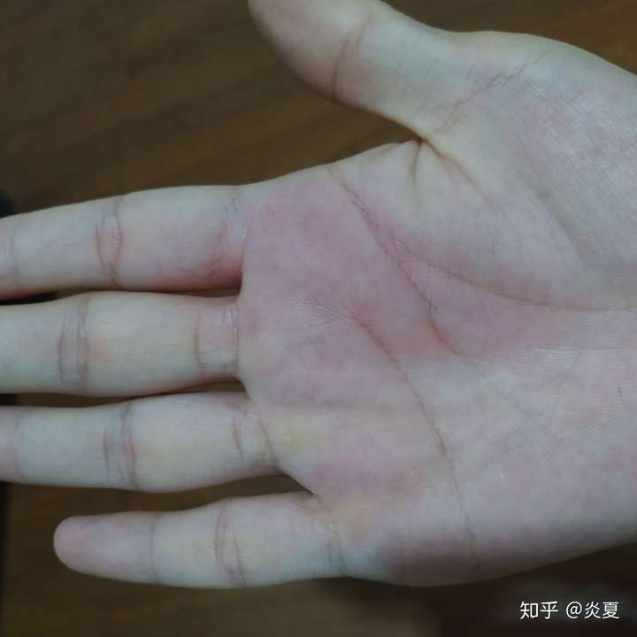 这次是手掌 ,身体素质太差了