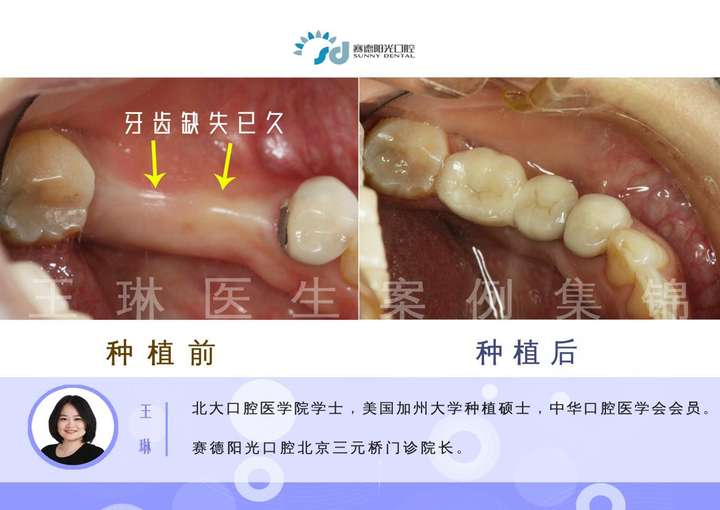 过去,牙齿缺失的修复方法主要有两种:固定义齿和活动义齿.