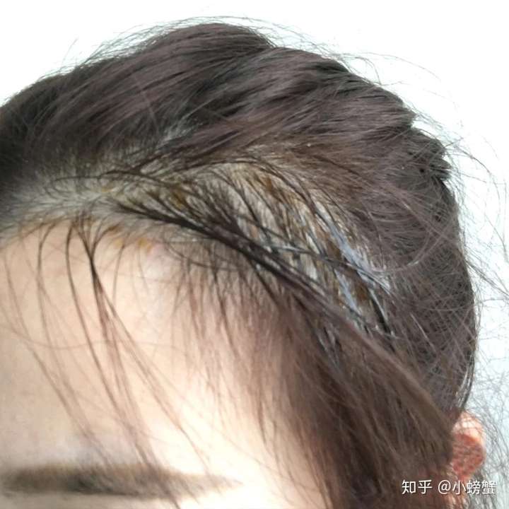 我是脂溢性脱发,在大学毕业之后因为外界因素,头发一缕一缕的往下掉