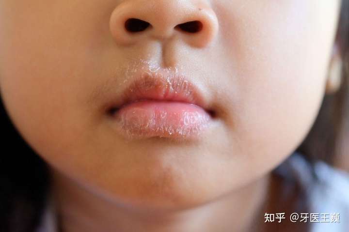 3,有咬唇习惯的儿童,唇部常有牙齿的咬迹, 易发生唇炎. 咬嘴唇是一
