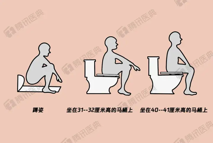 大便姿势的测试,分别以3种姿势排便,即:蹲着,坐在31~32cm高的马桶上