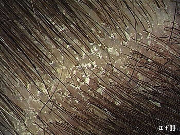 头皮屑的形成过程中,有两个很重要的要素,就是: 头皮分泌油脂,以油脂