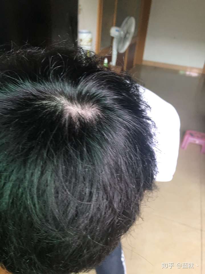 请问这个样子正常吗,平常洗头发会掉一百根左右,而且容易掉头发,但是