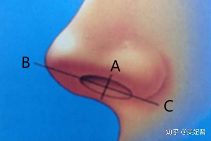 鼻翼缘-前鼻孔-鼻小柱复合体(ar)