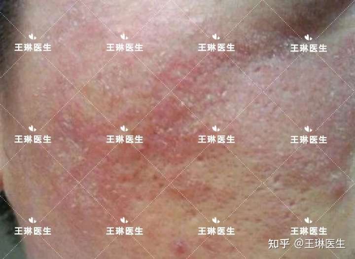 2,脂溢性皮炎可以侵犯的范围不小:面部,头皮,前胸或者后背, 只要存在