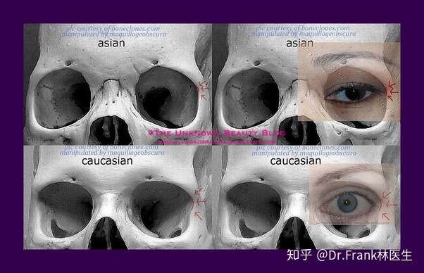东西方人眼眶骨骼的差异