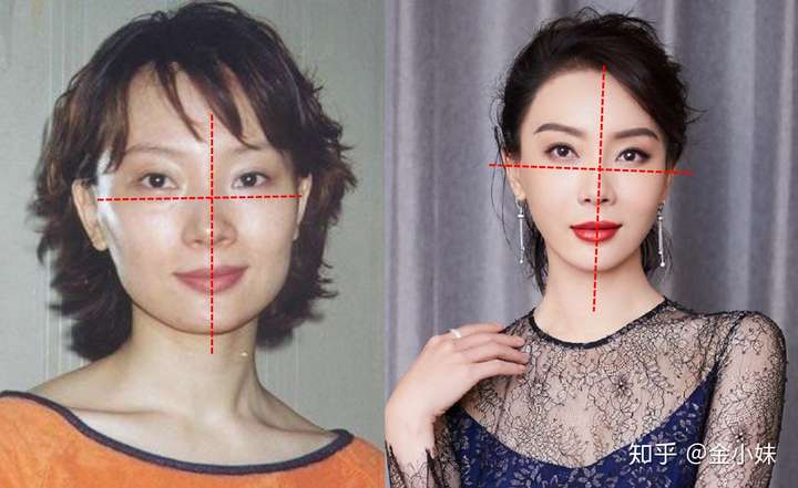 除了脸歪,还有「 眼眶骨上下错位」,导致眼睛一边高,另一边低.
