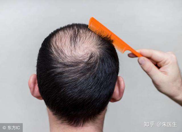 那么,遗传性脱发在两性中的表现有什么不同呢?