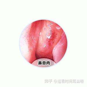 如何预防鼻息肉发生?