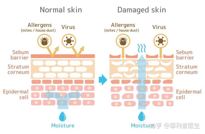 皮脂膜受损引起皮肤屏障破坏引起皮肤水分流失,敏感和易受感染来源