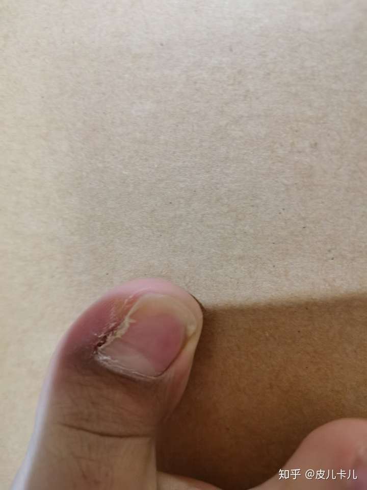就是趾甲长长了,扎着肉疼,有时候会戳个洞, 讲讲嵌甲怎么治,塞棉花