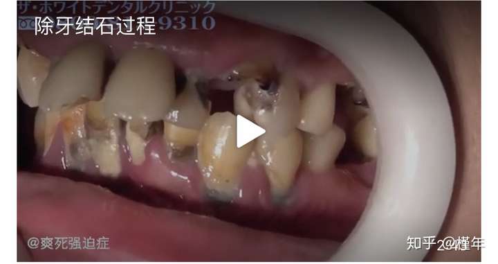 如果一个人从出生就不刷牙20年后牙是什么样子