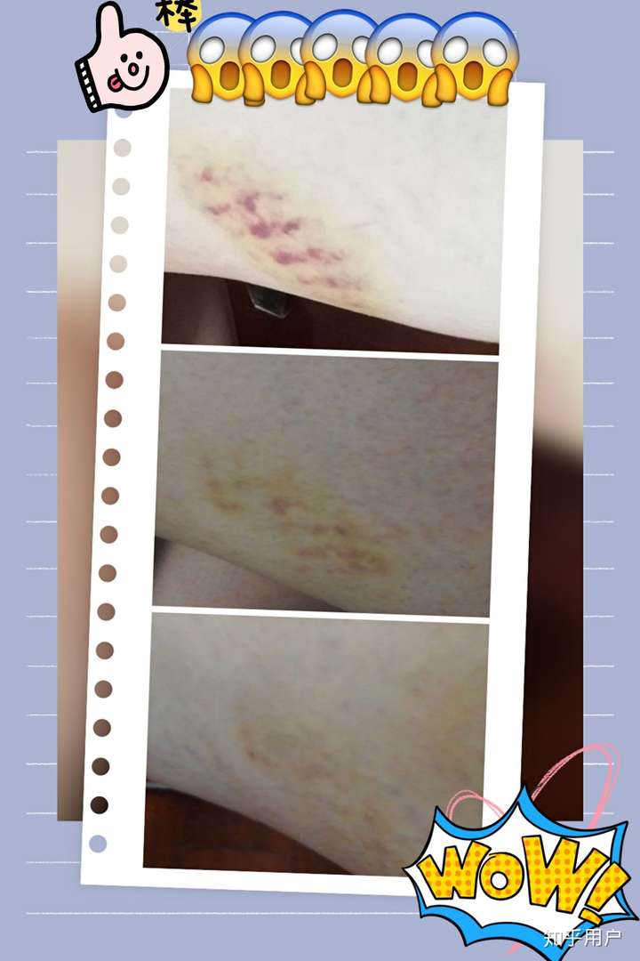 如何快速消除腿部由于碰撞造成的大面积淤青
