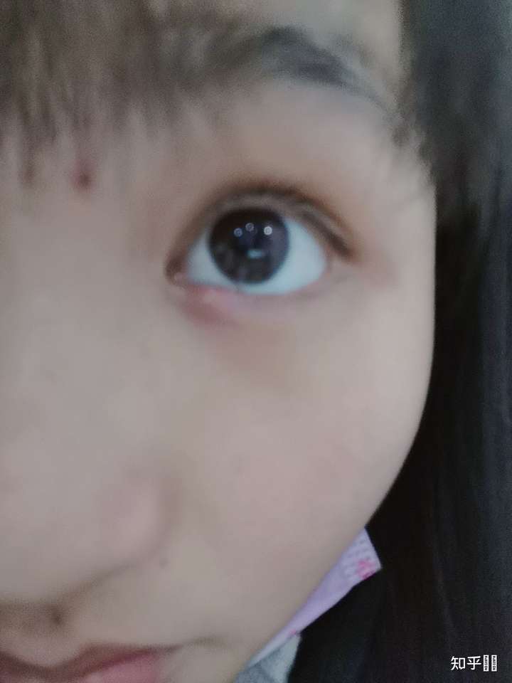 是外麦粒肿,刚长起来.
