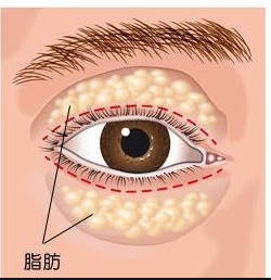 肿眼泡割双眼皮后脂肪会长回来吗?