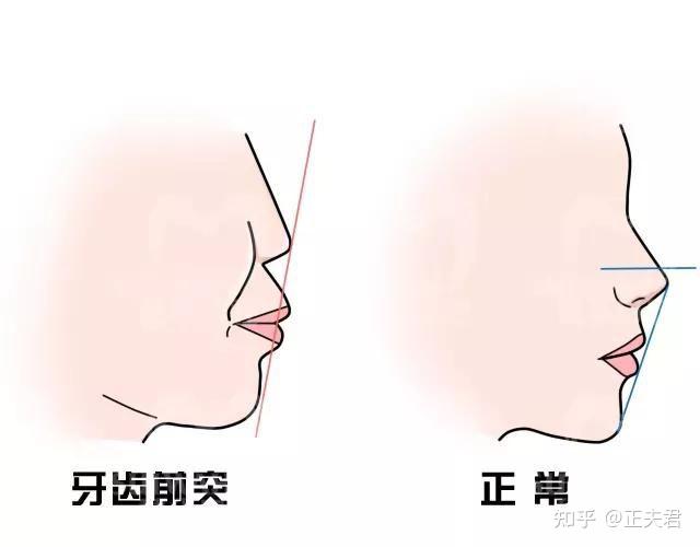 嘴突出的话,嘴周围,鼻子就会显得比较低,下巴看起来也向后收缩,同时