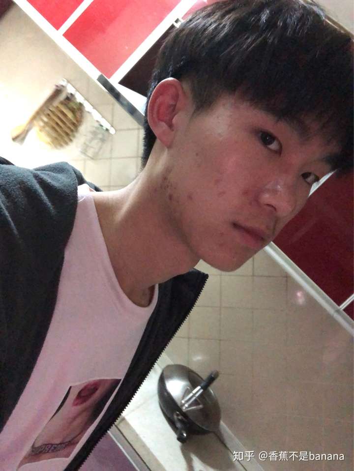 我觉得吧,痘痘的确蛮影响颜值的,有时候好看的衣服都不敢穿蛮自卑的