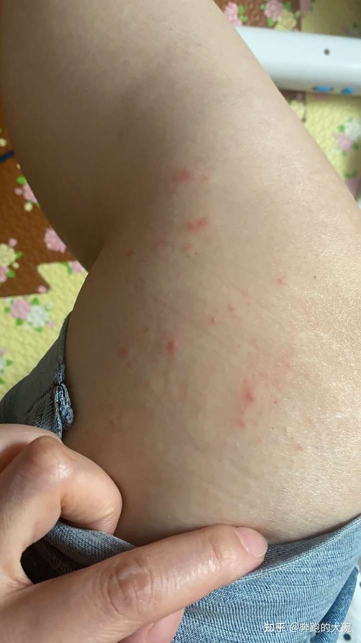 图三是被蚊子咬的,图一不知为啥离那也远的地方起了好多小红点,图二